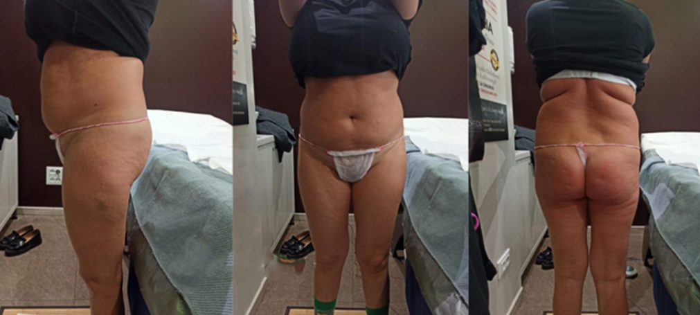 ADIPOUT PRIMA E DOPO 1a ADIPOUT PRIMA E DOPO 1a
